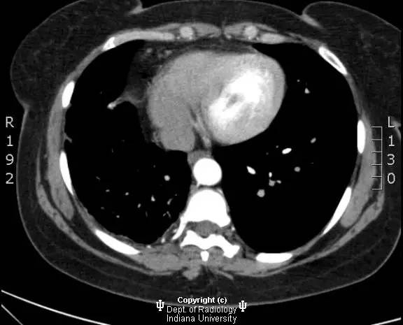 【病例】纤维性纵膈炎1例X线CT影像表现 【病例】纤维性纵膈炎1例X线CT影像表现