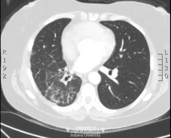 【病例】纤维性纵膈炎1例X线CT影像表现 【病例】纤维性纵膈炎1例X线CT影像表现