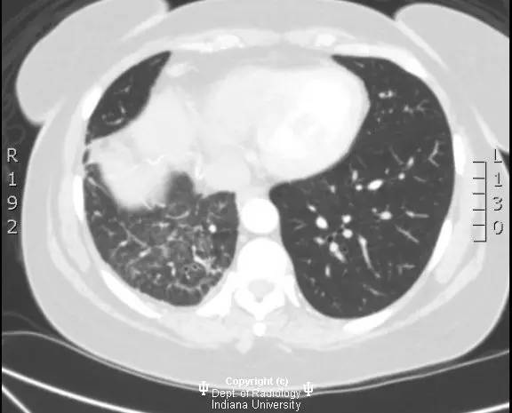 【病例】纤维性纵膈炎1例X线CT影像表现 【病例】纤维性纵膈炎1例X线CT影像表现