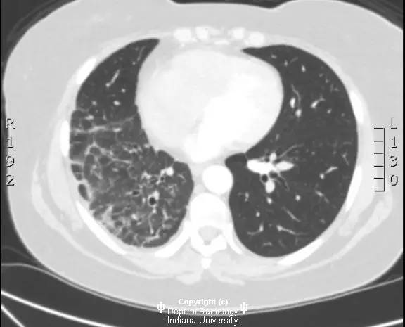 【病例】纤维性纵膈炎1例X线CT影像表现 【病例】纤维性纵膈炎1例X线CT影像表现