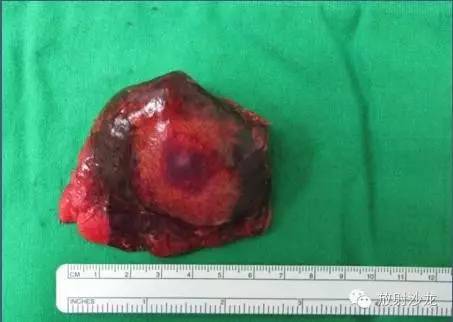【病例】肺内子宫内膜异位症1例CT影像表现 【病例】肺内子宫内膜异位症1例CT影像表现