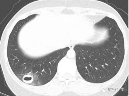 【病例】肺内子宫内膜异位症1例CT影像表现 【病例】肺内子宫内膜异位症1例CT影像表现