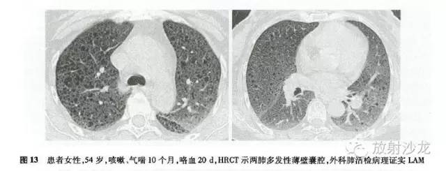 【病例】Birt-Hogg-Dube综合征1例CT影像表现 【病例】Birt-Hogg-Dube综合征1例CT影像表现