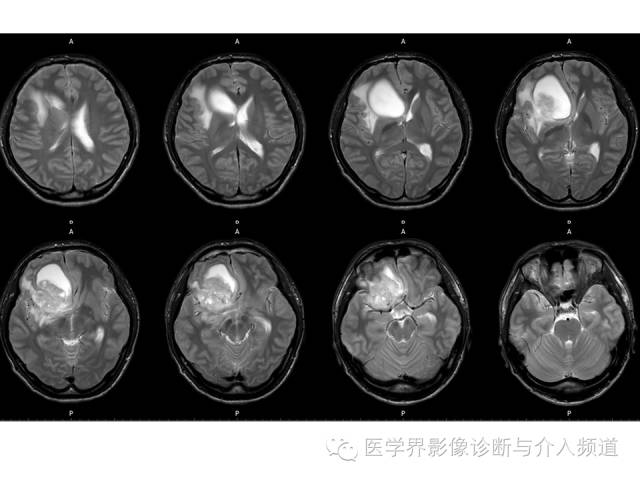 【病例】右额叶CNS原始神经外胚层肿瘤PNET一例 【病例】右额叶CNS原始神经外胚层肿瘤PNET一例