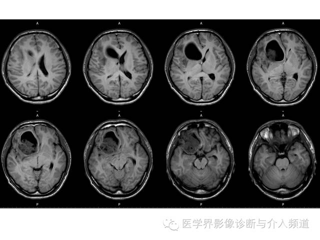 【病例】右额叶CNS原始神经外胚层肿瘤PNET一例 【病例】右额叶CNS原始神经外胚层肿瘤PNET一例
