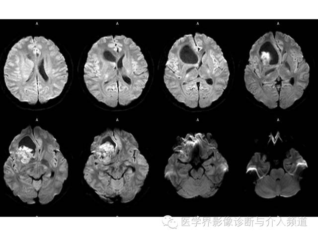 【病例】右额叶CNS原始神经外胚层肿瘤PNET一例 【病例】右额叶CNS原始神经外胚层肿瘤PNET一例