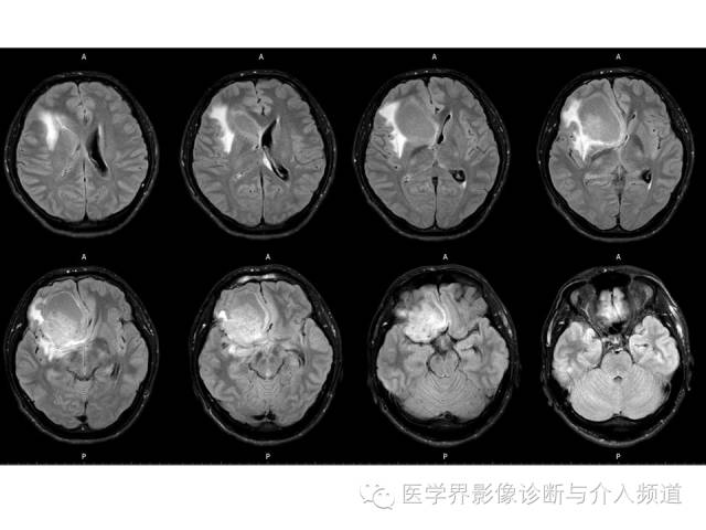 【病例】右额叶CNS原始神经外胚层肿瘤PNET一例 【病例】右额叶CNS原始神经外胚层肿瘤PNET一例