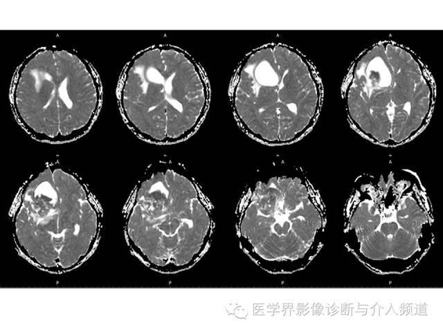 【病例】右额叶CNS原始神经外胚层肿瘤PNET一例 【病例】右额叶CNS原始神经外胚层肿瘤PNET一例