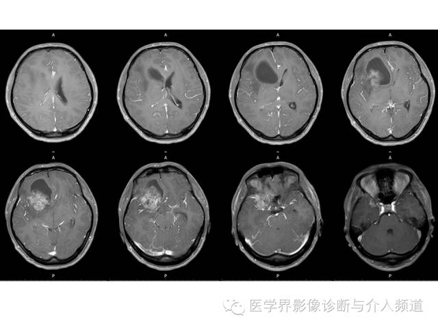 【病例】右额叶CNS原始神经外胚层肿瘤PNET一例 【病例】右额叶CNS原始神经外胚层肿瘤PNET一例