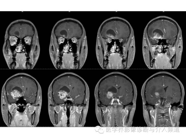 【病例】右额叶CNS原始神经外胚层肿瘤PNET一例 【病例】右额叶CNS原始神经外胚层肿瘤PNET一例
