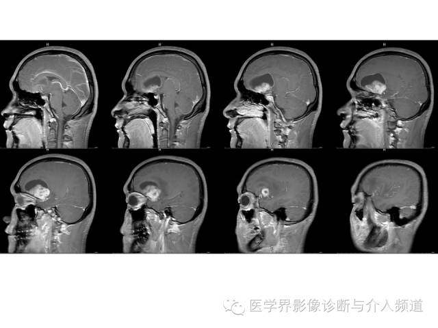 【病例】右额叶CNS原始神经外胚层肿瘤PNET一例 【病例】右额叶CNS原始神经外胚层肿瘤PNET一例