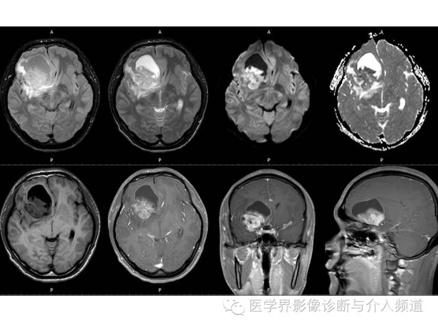 【病例】右额叶CNS原始神经外胚层肿瘤PNET一例 【病例】右额叶CNS原始神经外胚层肿瘤PNET一例