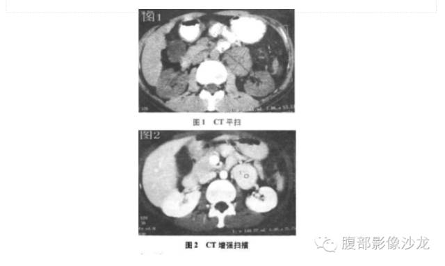 【病例】Castleman病2例CT影像表现 【病例】Castleman病2例CT影像表现