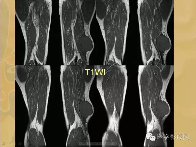 【病例】大腿恶性纤维组织细胞瘤1例MR影像表现