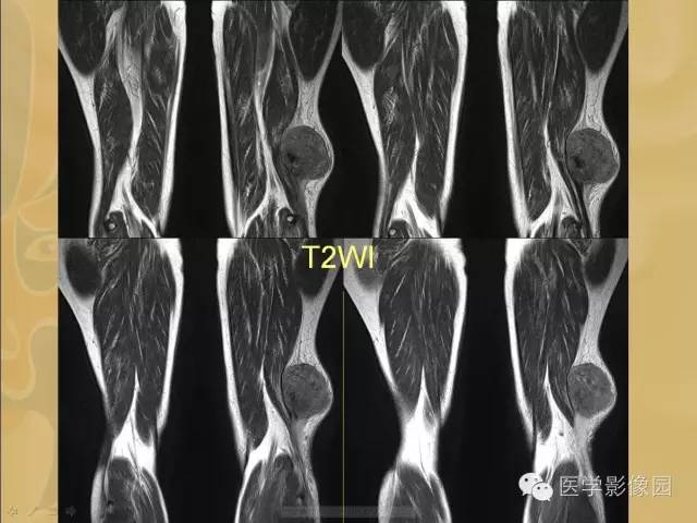 【病例】大腿恶性纤维组织细胞瘤1例MR影像表现 【病例】大腿恶性纤维组织细胞瘤1例MR影像表现