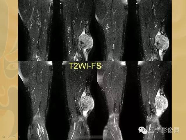 【病例】大腿恶性纤维组织细胞瘤1例MR影像表现 【病例】大腿恶性纤维组织细胞瘤1例MR影像表现