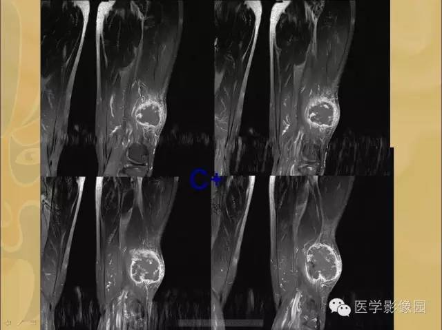 【病例】大腿恶性纤维组织细胞瘤1例MR影像表现 【病例】大腿恶性纤维组织细胞瘤1例MR影像表现