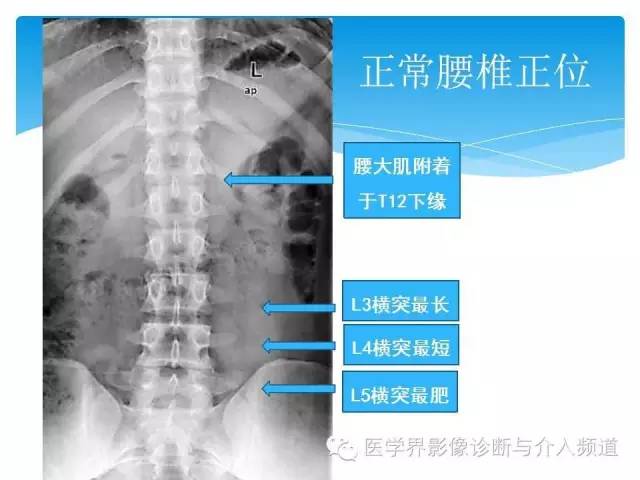 【PPT】永远说不清楚的移行椎