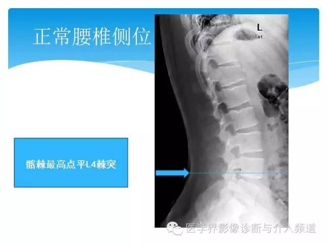 【PPT】永远说不清楚的移行椎