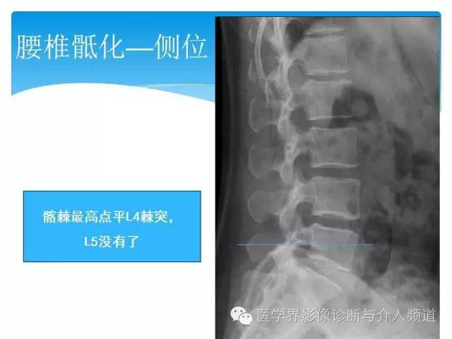 【PPT】永远说不清楚的移行椎