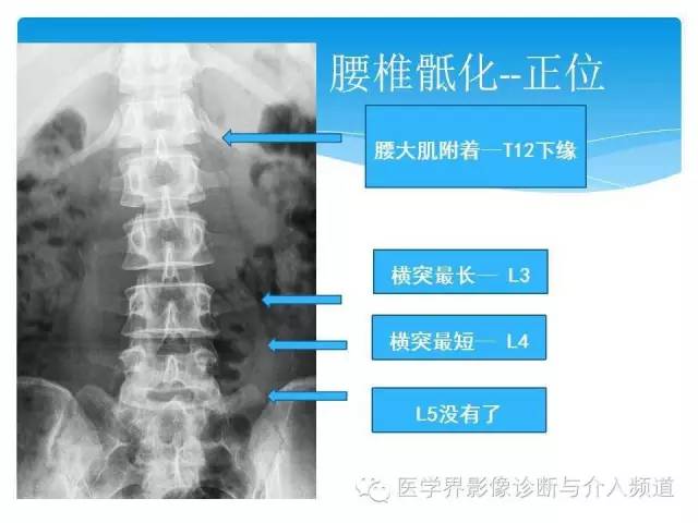 【PPT】永远说不清楚的移行椎