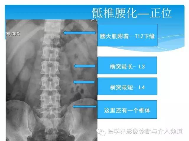 【PPT】永远说不清楚的移行椎