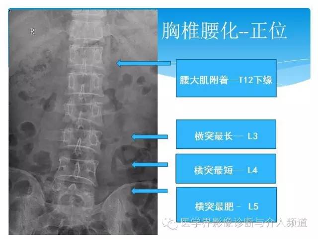 【PPT】永远说不清楚的移行椎