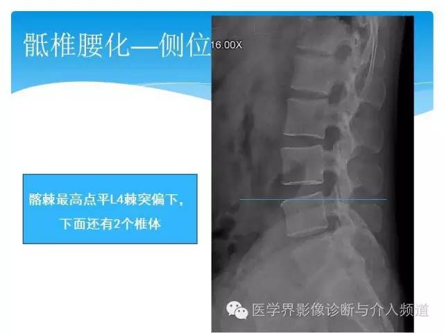 【PPT】永远说不清楚的移行椎