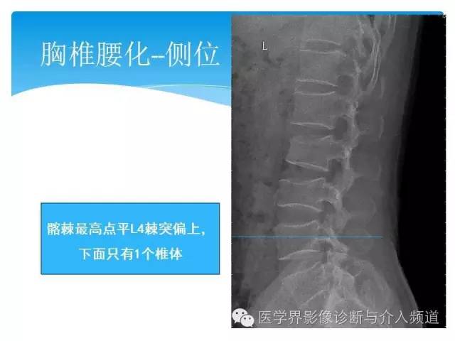 【PPT】永远说不清楚的移行椎