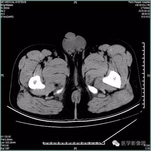 【病例】阴囊腺瘤样瘤1例CT影像表现 【病例】阴囊腺瘤样瘤1例CT影像表现