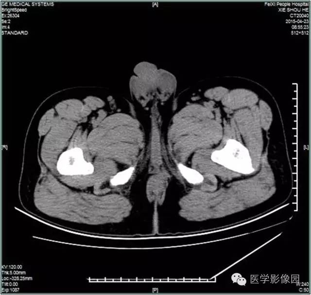 【病例】阴囊腺瘤样瘤1例CT影像表现 【病例】阴囊腺瘤样瘤1例CT影像表现