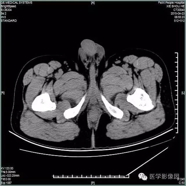 【病例】阴囊腺瘤样瘤1例CT影像表现 【病例】阴囊腺瘤样瘤1例CT影像表现