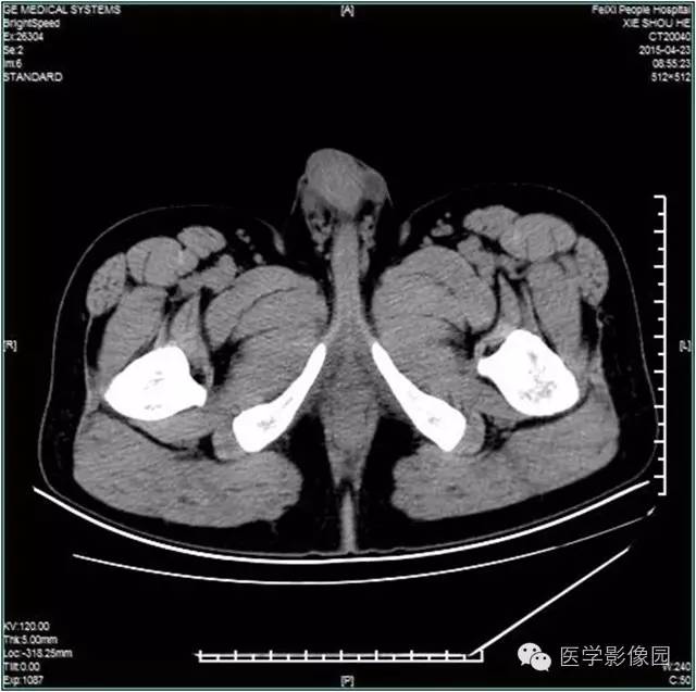 【病例】阴囊腺瘤样瘤1例CT影像表现 【病例】阴囊腺瘤样瘤1例CT影像表现