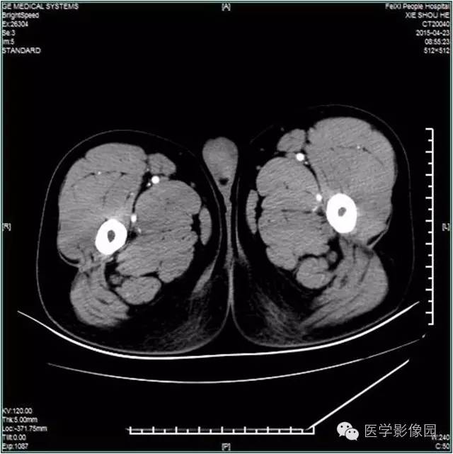 【病例】阴囊腺瘤样瘤1例CT影像表现 【病例】阴囊腺瘤样瘤1例CT影像表现