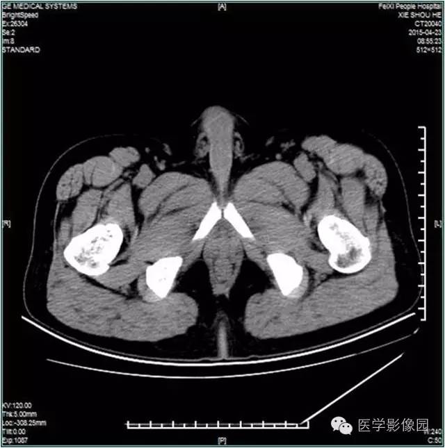 【病例】阴囊腺瘤样瘤1例CT影像表现 【病例】阴囊腺瘤样瘤1例CT影像表现