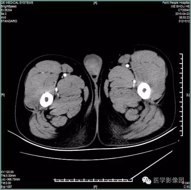 【病例】阴囊腺瘤样瘤1例CT影像表现 【病例】阴囊腺瘤样瘤1例CT影像表现