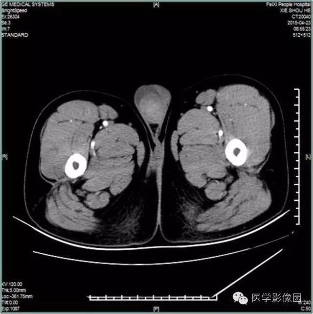 【病例】阴囊腺瘤样瘤1例CT影像表现 【病例】阴囊腺瘤样瘤1例CT影像表现