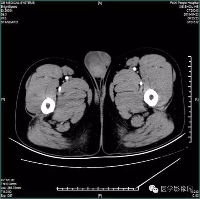 【病例】阴囊腺瘤样瘤1例CT影像表现 【病例】阴囊腺瘤样瘤1例CT影像表现