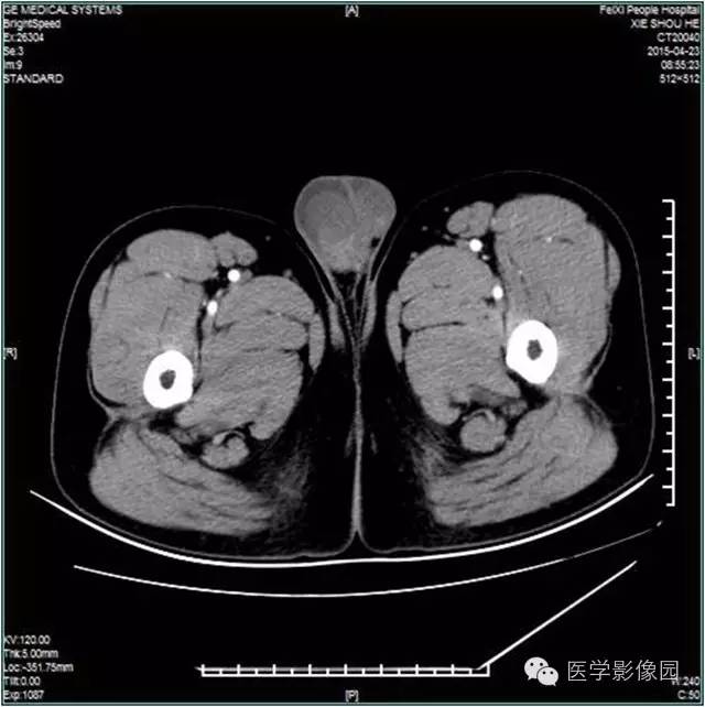 【病例】阴囊腺瘤样瘤1例CT影像表现 【病例】阴囊腺瘤样瘤1例CT影像表现
