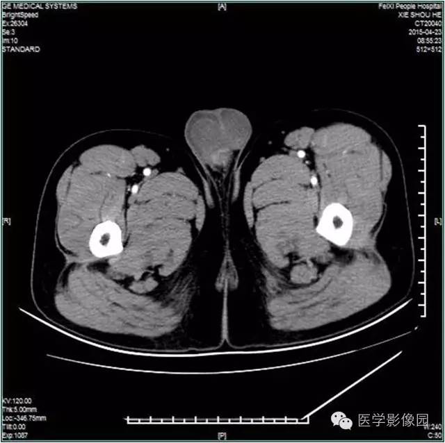 【病例】阴囊腺瘤样瘤1例CT影像表现 【病例】阴囊腺瘤样瘤1例CT影像表现