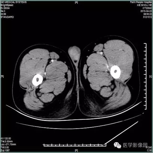 【病例】阴囊腺瘤样瘤1例CT影像表现 【病例】阴囊腺瘤样瘤1例CT影像表现