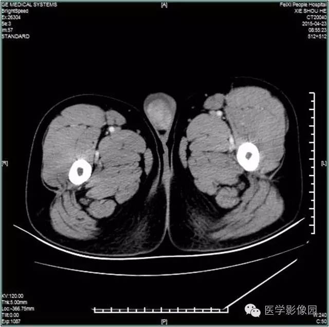 【病例】阴囊腺瘤样瘤1例CT影像表现 【病例】阴囊腺瘤样瘤1例CT影像表现