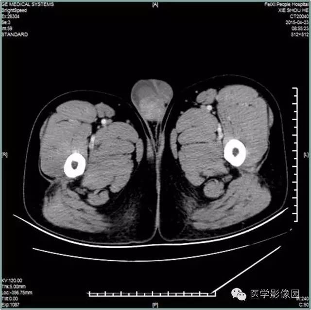 【病例】阴囊腺瘤样瘤1例CT影像表现 【病例】阴囊腺瘤样瘤1例CT影像表现