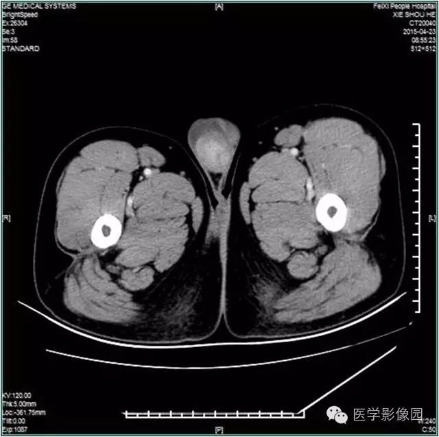 【病例】阴囊腺瘤样瘤1例CT影像表现 【病例】阴囊腺瘤样瘤1例CT影像表现