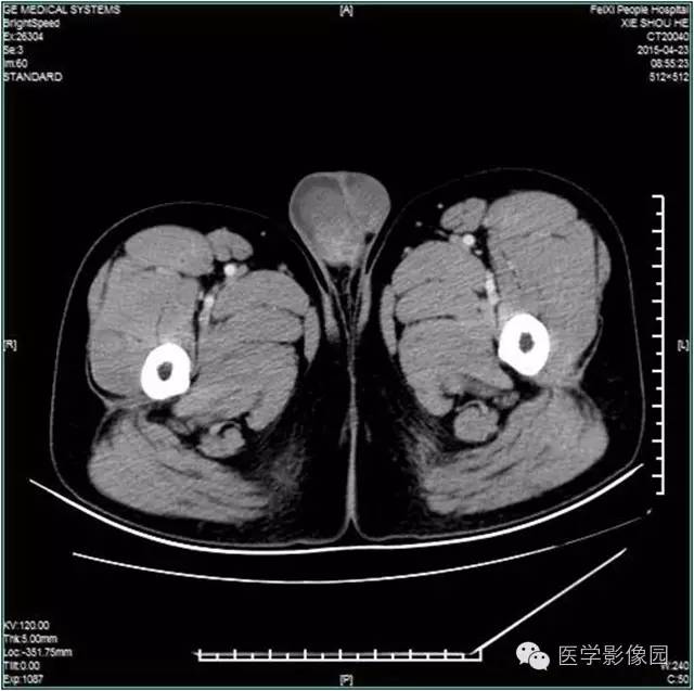 【病例】阴囊腺瘤样瘤1例CT影像表现 【病例】阴囊腺瘤样瘤1例CT影像表现