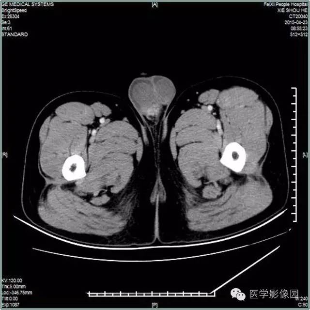 【病例】阴囊腺瘤样瘤1例CT影像表现 【病例】阴囊腺瘤样瘤1例CT影像表现