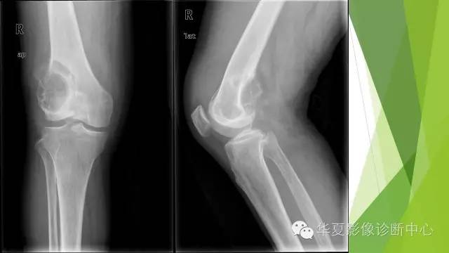 【病例】骨巨细胞瘤3例影像诊断与鉴别