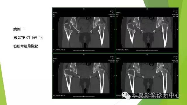 【病例】骨巨细胞瘤3例影像诊断与鉴别