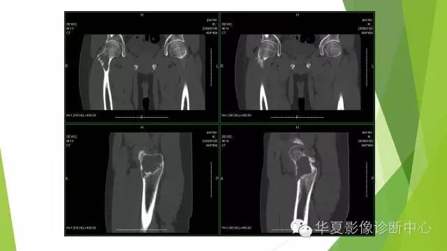【病例】骨巨细胞瘤3例影像诊断与鉴别