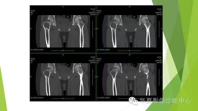 【病例】骨巨细胞瘤3例影像诊断与鉴别
